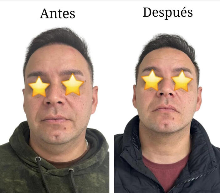Caso 3 Bichectomía Talca rostro masculino pómulos definidos