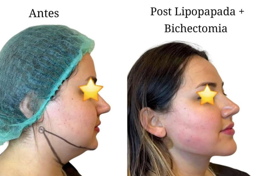Antes y después lipopapada Talca paciente mujer perfil