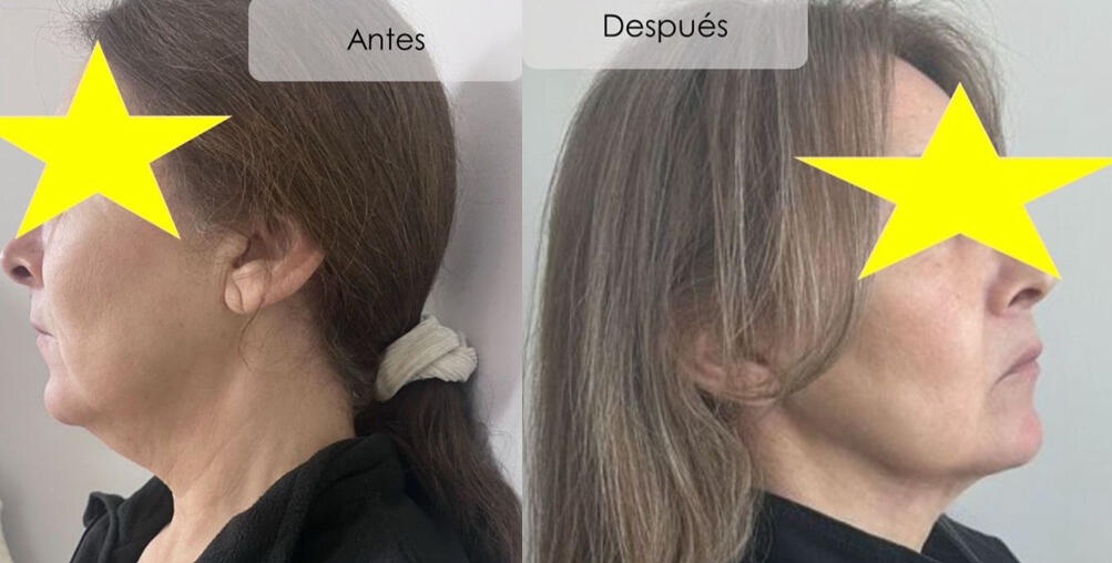 Antes y después lipopapada Talca paciente mujer perfil
