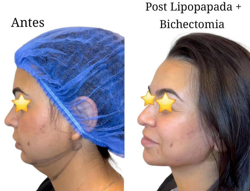 Antes y después lipopapada Talca paciente mujer perfil