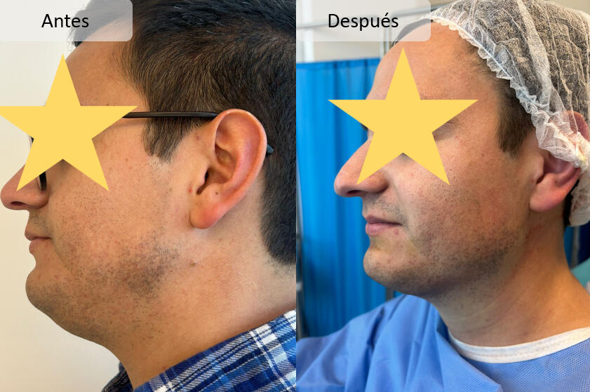 Lipopapada Talca rostro masculino mandíbula marcada